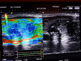 Adenoma di Plummer Lobo sx trattato con M31
