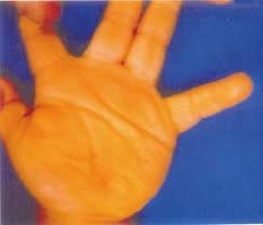 Carotenodermia
