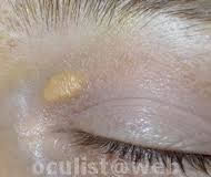 Xantelasmi