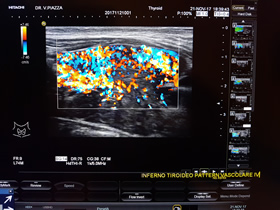 M. di Basedow - Elasticity score 1 (veri soft) con pattern vascolare IV