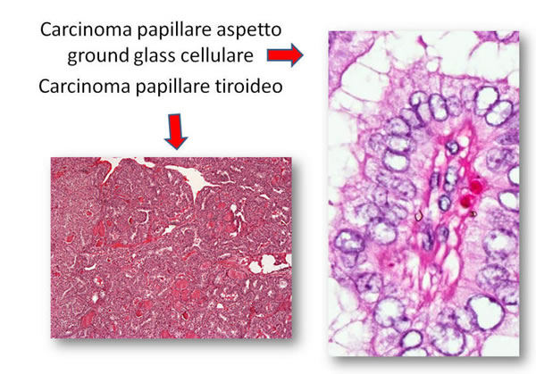 Carcinoma papillare tiroideo