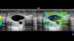 Cisti: aspetto elastosonografico tristratificato