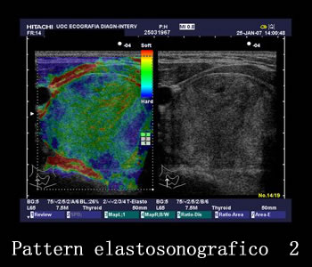 Pattern elastosonografico 2