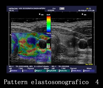 Pattern elastosonografico 4