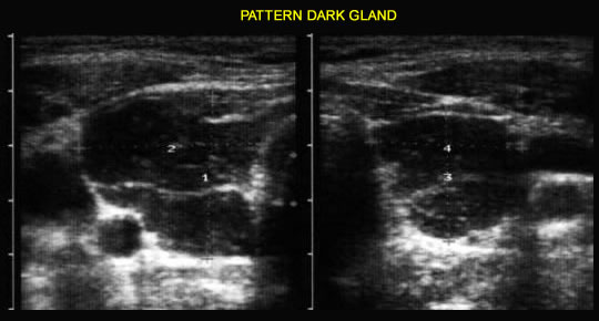 Ecografia Tiroidite di Hashimoto - Pattern Dark Gland