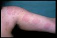 Orticaria