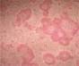 Orticaria