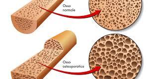 OSSO E TIROIDE : Azioni e meccanismi biochimico-molecolari degli ormoni tiroidei su osso e osteoporosi